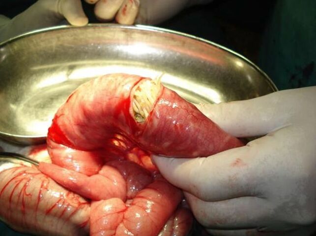 worms in human intestine