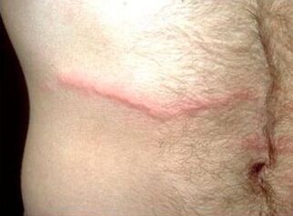 How to get rid of subcutaneous parasites in humans