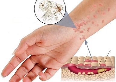 Manifestations of the presence of subcutaneous parasites in humans