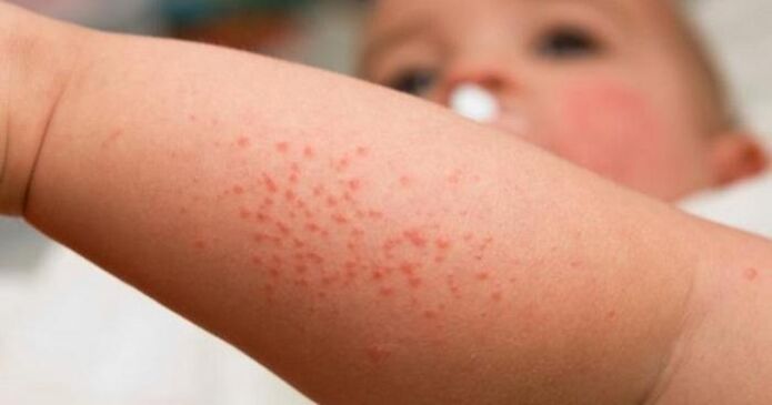 rash as a symptom of parasitic infection