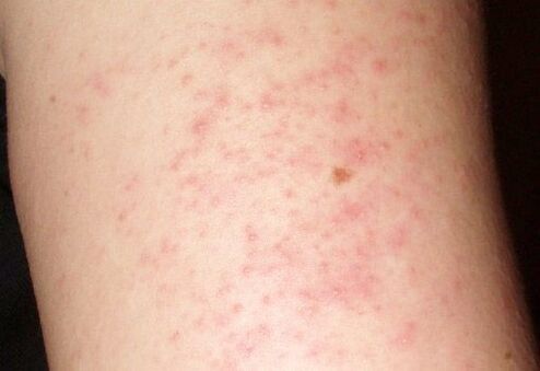 Itchy rashes are a symptom of the presence of liver flukes