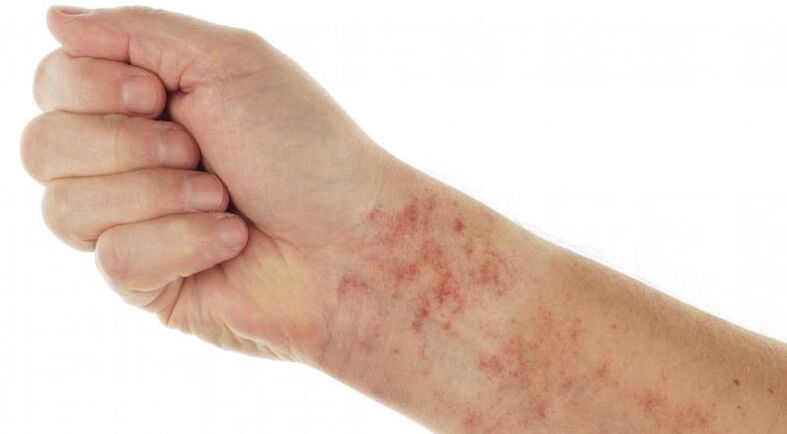 rashes in the presence of parasites on the body